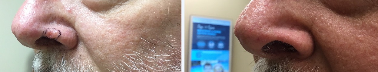 Before & After Left ala ()