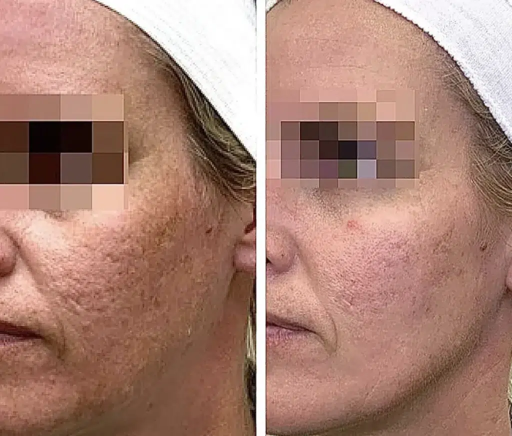 SecretRF before and after photo by Elite Dermatology Plastic Surgery in Houston, TX