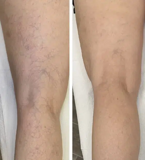 VBeam before and after photo by Elite Dermatology Plastic Surgery in Houston, TX