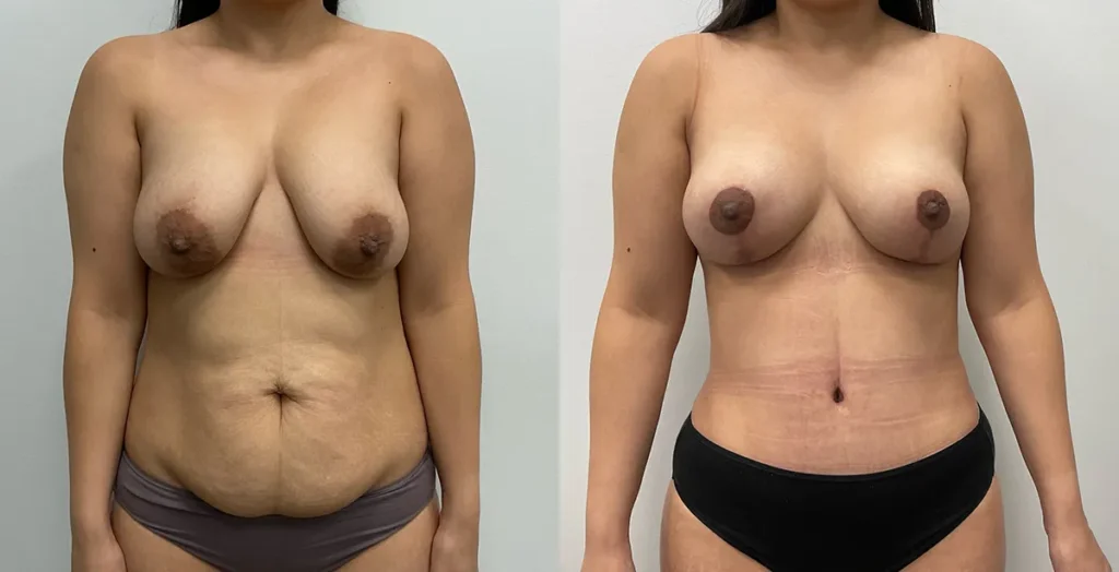 Mommy Makeover before and after photo by Elite Dermatology Plastic Surgery in Houston, TX