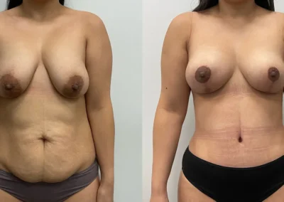 Mommy Makeover before and after photo by Elite Dermatology Plastic Surgery in Houston, TX