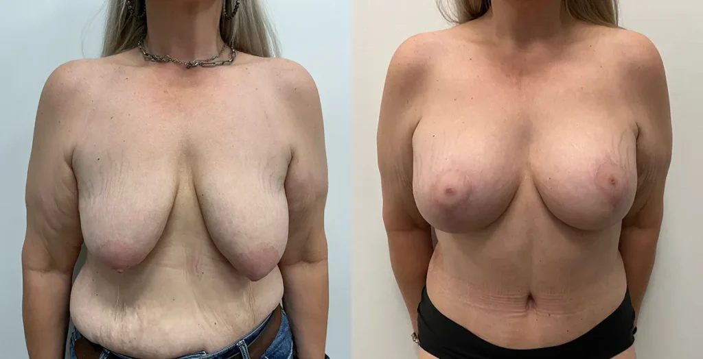 Mommy Makeover before and after photo by Elite Dermatology Plastic Surgery in Houston, TX