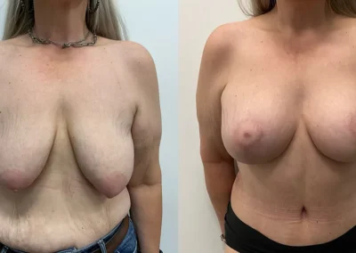 Mommy Makeover before and after photo by Elite Dermatology Plastic Surgery in Houston, TX