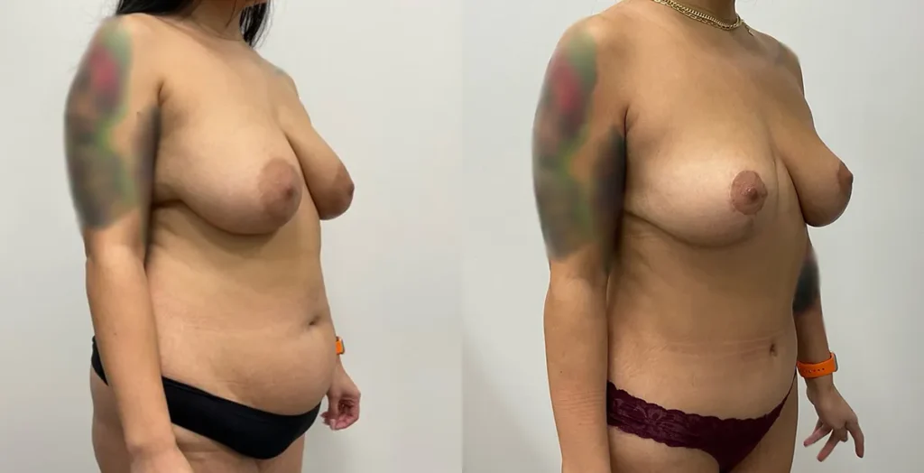 Mommy Makeover before and after photo by Elite Dermatology Plastic Surgery in Houston, TX