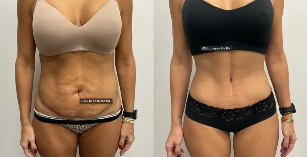 Mommy Makeover before and after photo by Elite Dermatology Plastic Surgery in Houston, TX