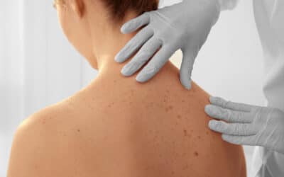 Skin Cancer: Early Detection, Warning Signs, and When to See a Dermatologist